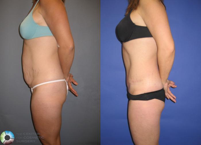 Before & After Tummy Tuck Case 203 View #3 View in Golden, CO