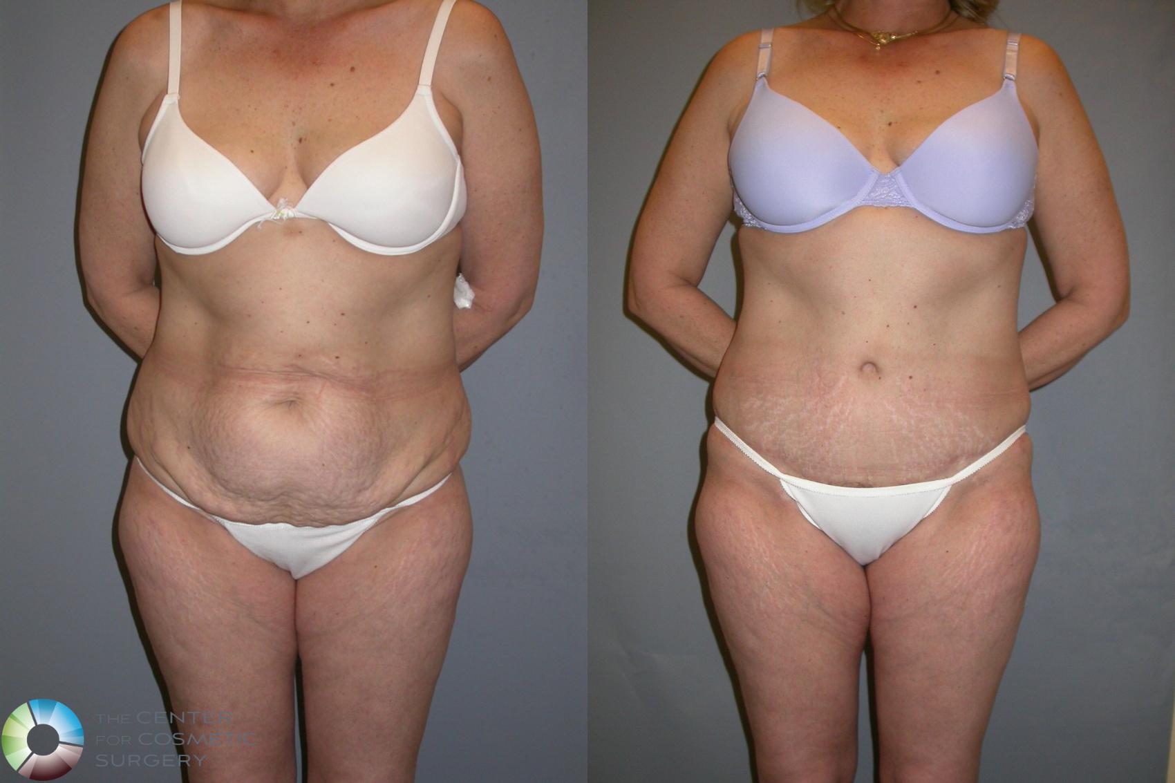 Before & After Tummy Tuck Case 204 View #1 in Denver and Colorado Springs, CO