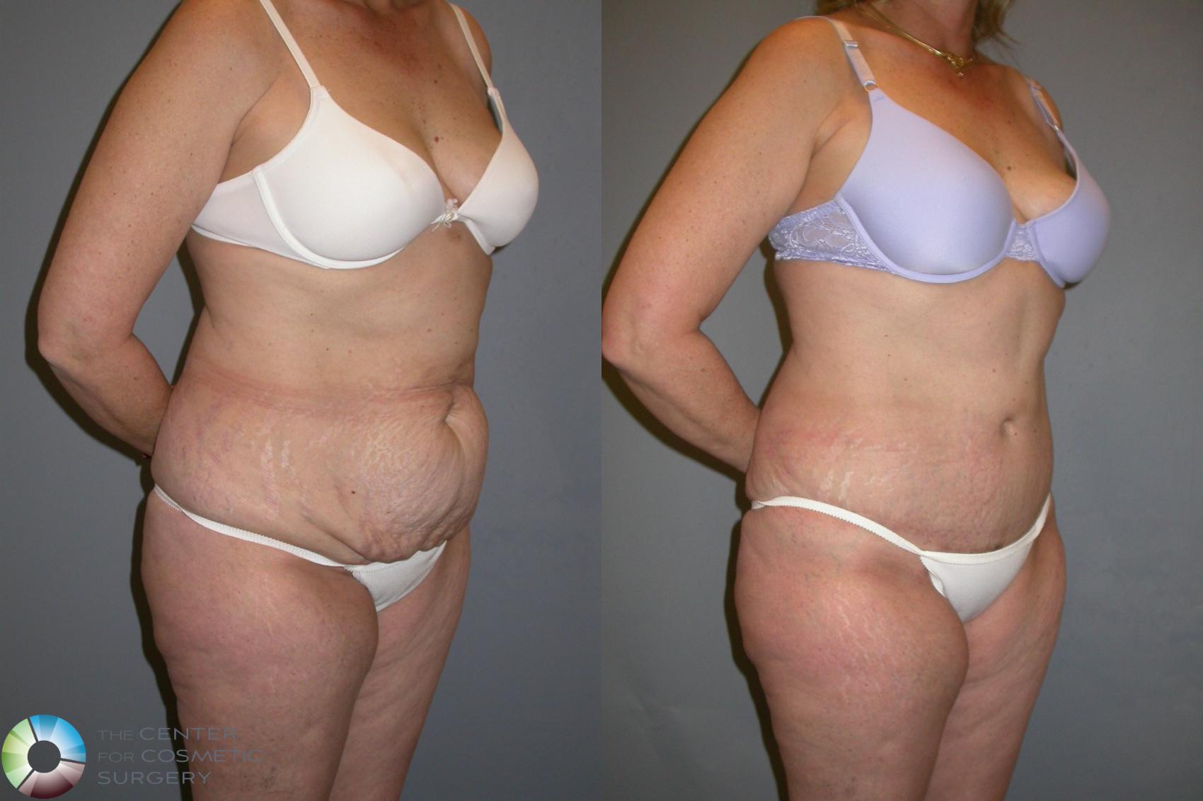 Before & After Tummy Tuck Case 204 View #2 View in Golden, CO