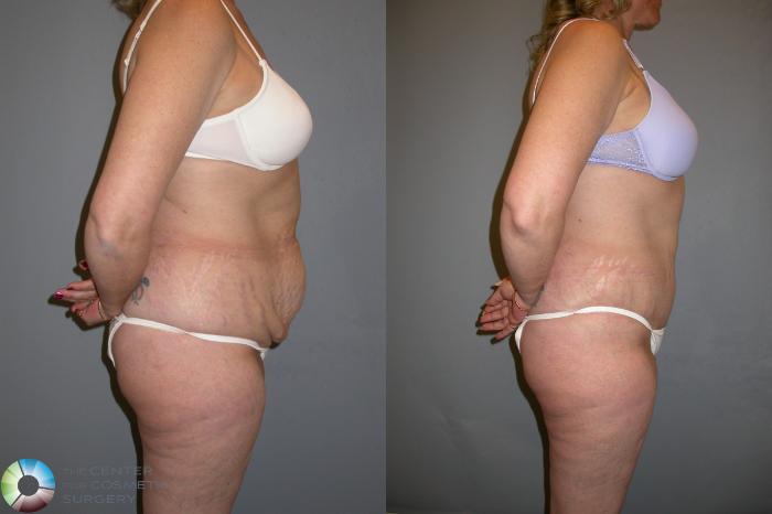 Before & After Tummy Tuck Case 204 View #3 View in Golden, CO