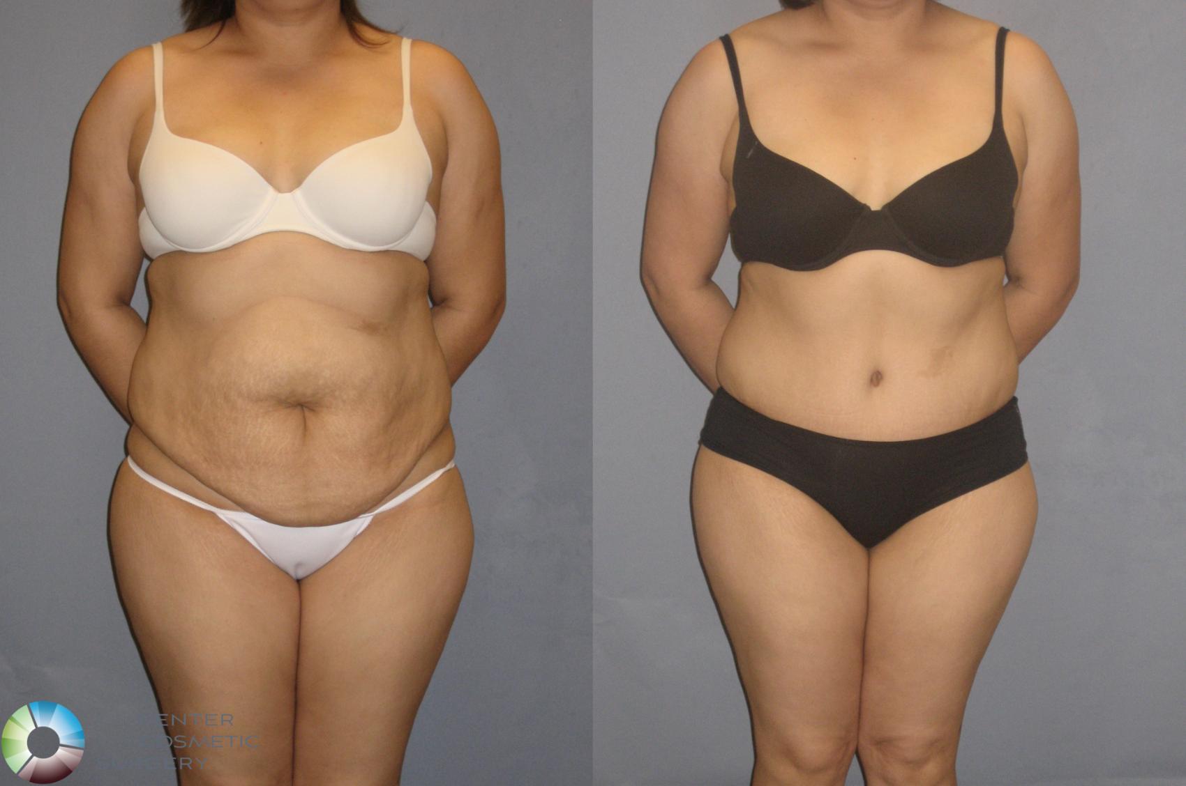 Tummy Tuck Before and After Pictures Case 69