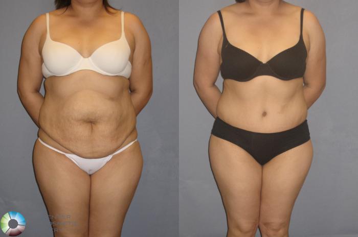 Before & After Tummy Tuck Case 205 View #1 View in Golden, CO