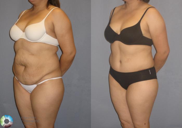 Before & After Tummy Tuck Case 205 View #2 View in Golden, CO