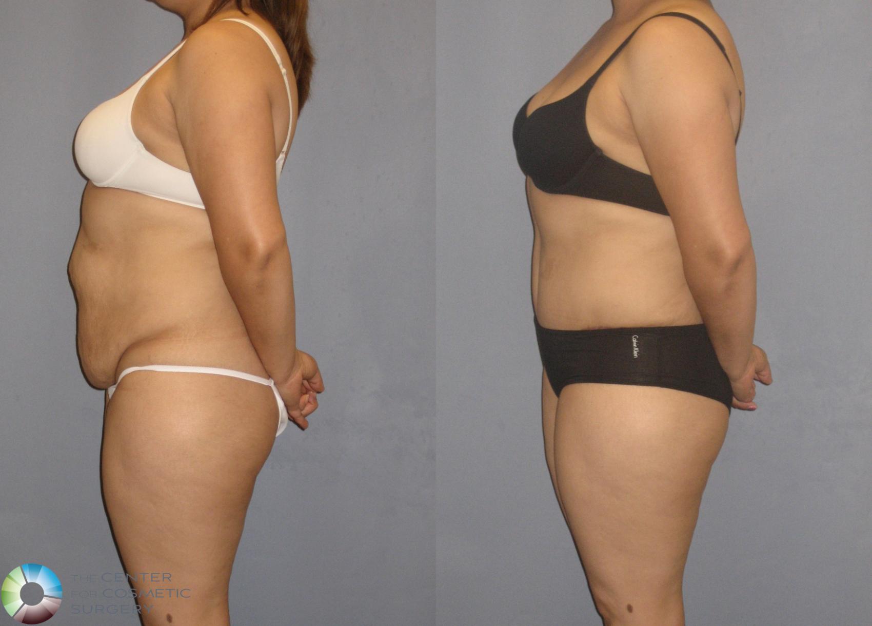Before & After Tummy Tuck Case 205 View #3 View in Golden, CO
