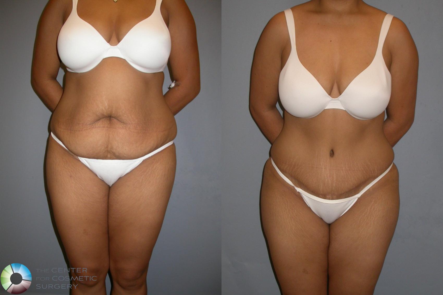 Before & After Tummy Tuck Case 206 View #1 in Denver and Colorado Springs, CO