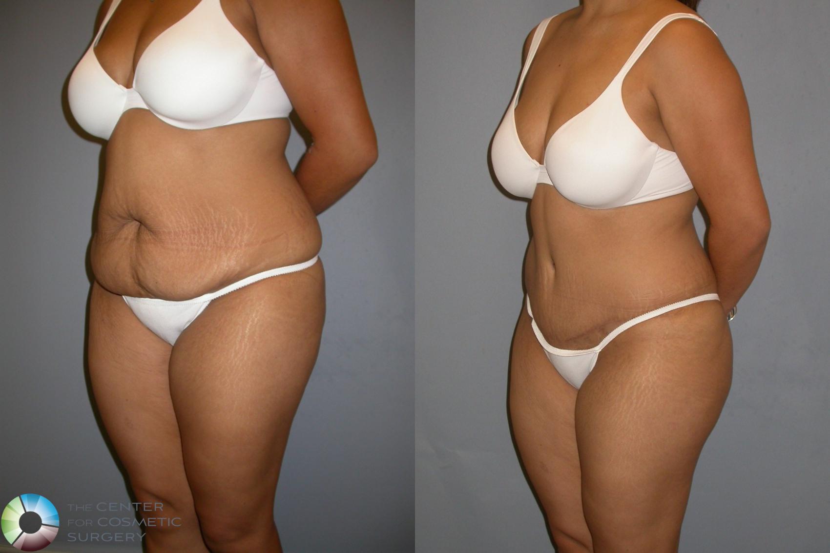 Before & After Tummy Tuck Case 206 View #2 in Denver and Colorado Springs, CO