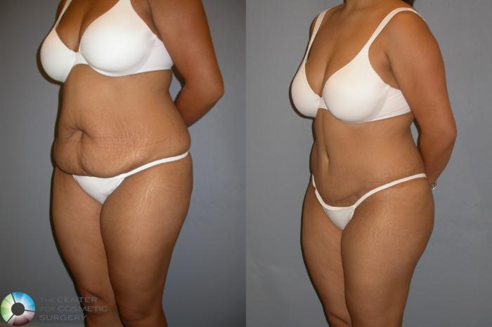 Before & After Tummy Tuck Case 206 View #2 View in Golden, CO