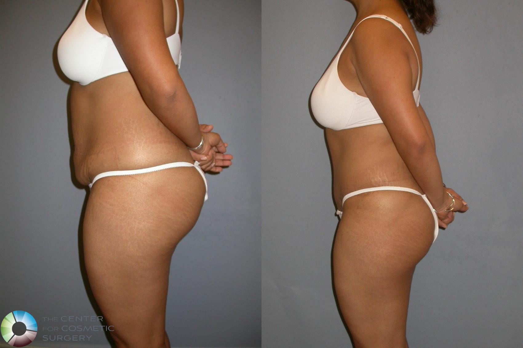 Before & After Tummy Tuck Case 206 View #3 in Denver and Colorado Springs, CO