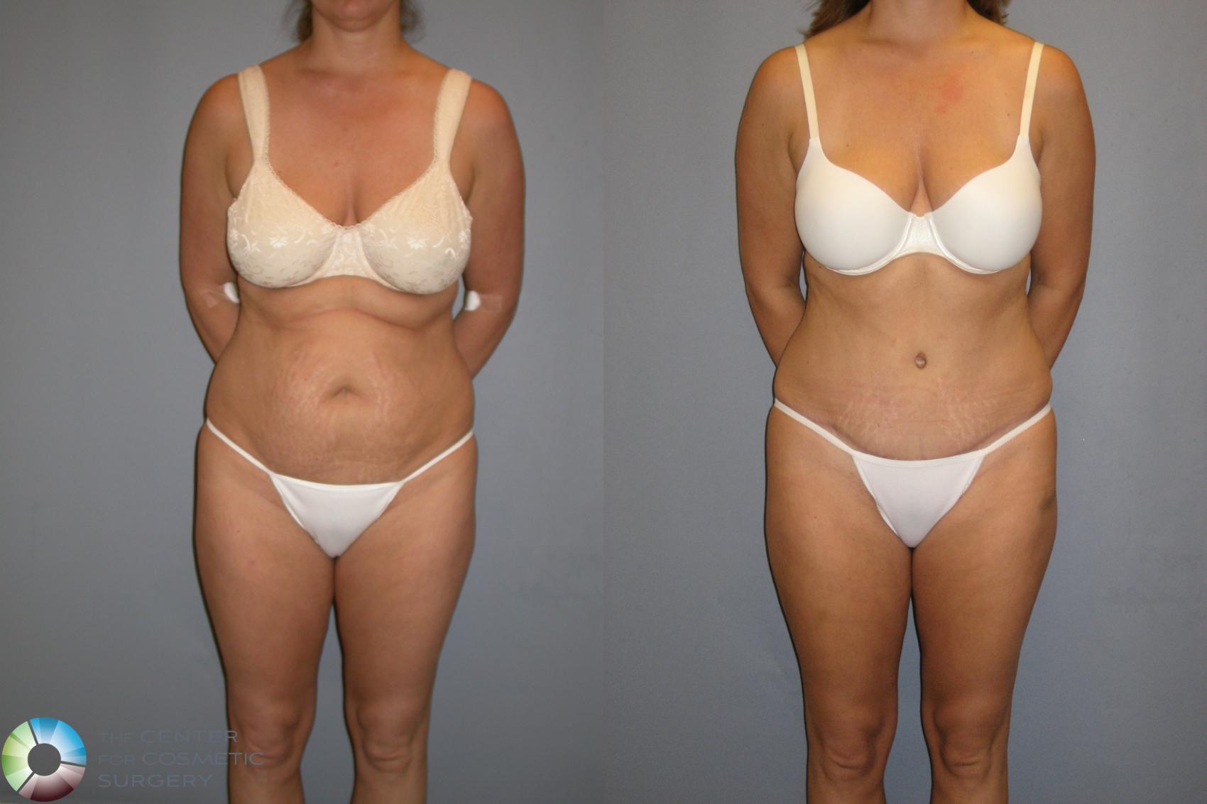 Before & After Tummy Tuck Case 207 View #1 in Denver and Colorado Springs, CO