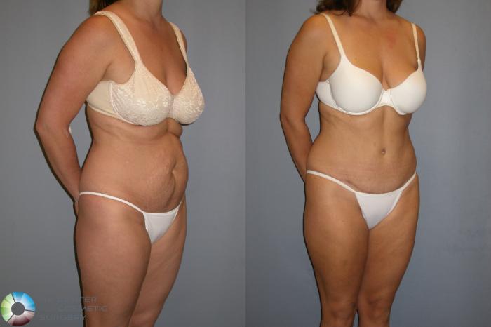 Before & After Tummy Tuck Case 207 View #2 View in Golden, CO