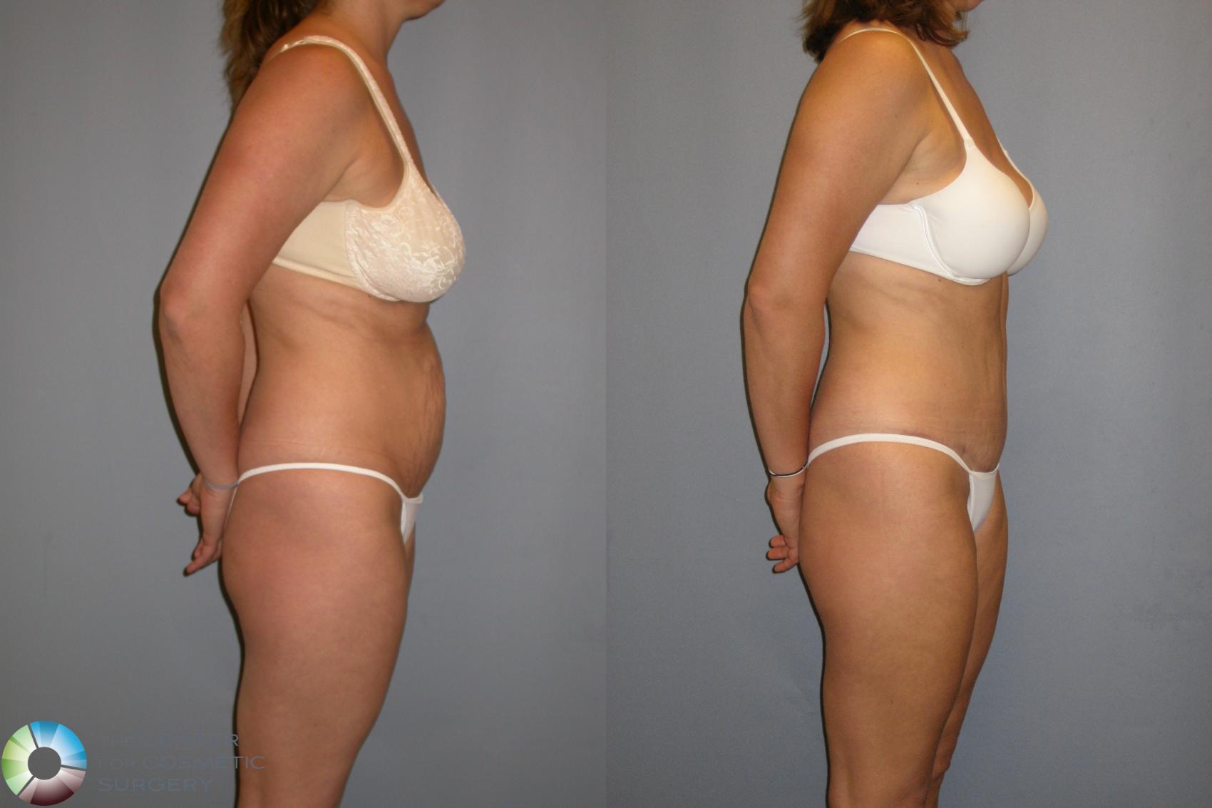 Before & After Tummy Tuck Case 207 View #3 View in Golden, CO