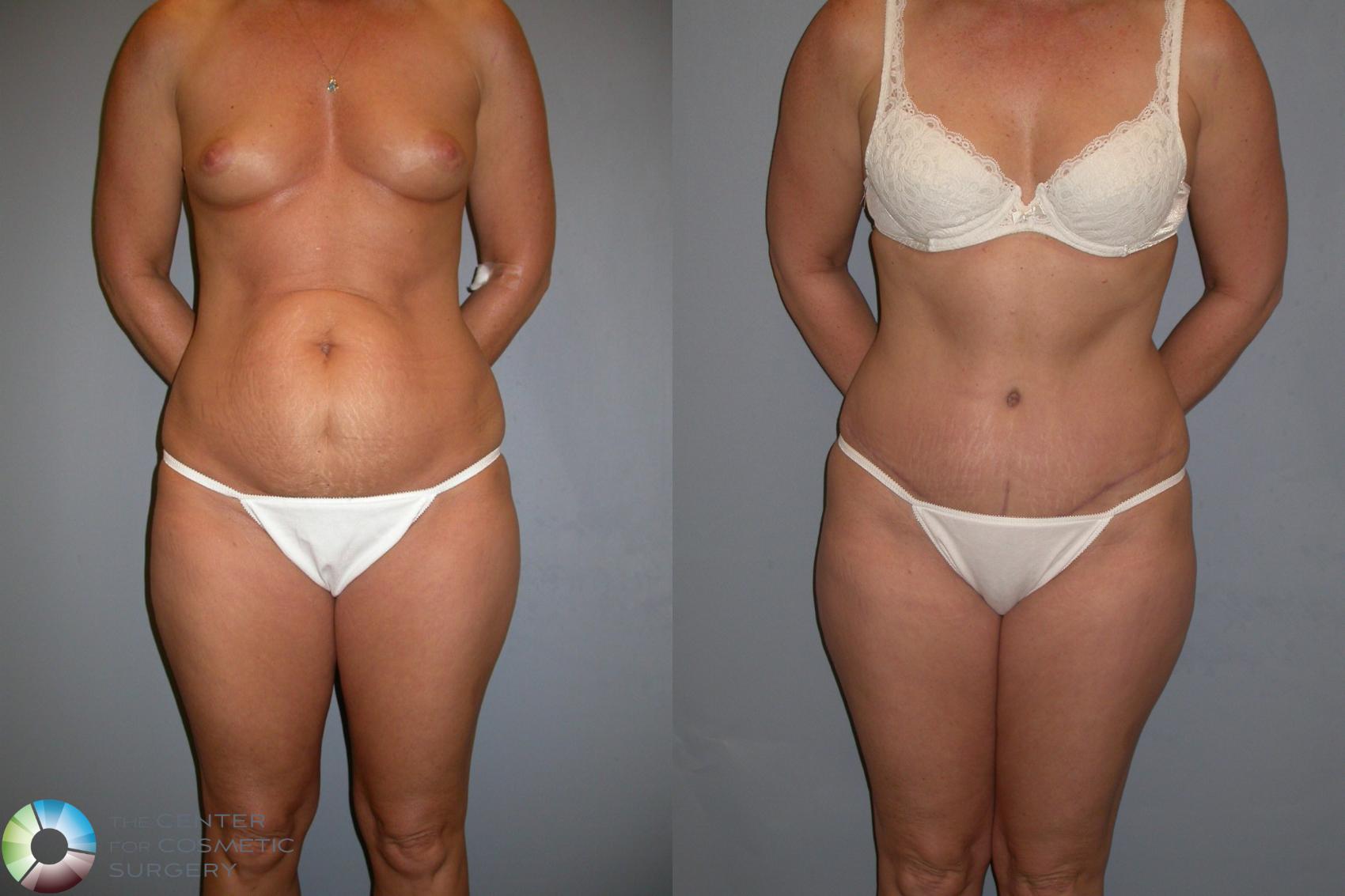 Before & After Tummy Tuck Case 212 View #1 in Denver and Colorado Springs, CO