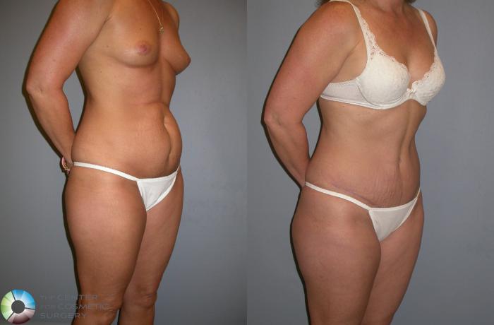 Before & After Tummy Tuck Case 212 View #2 View in Golden, CO