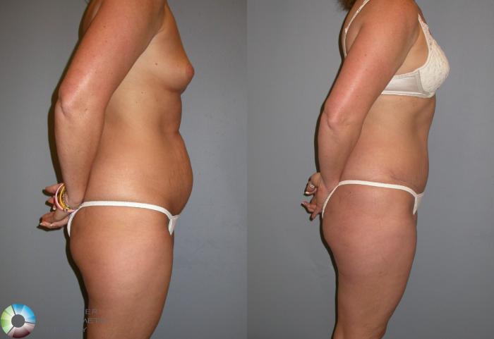 Before & After Tummy Tuck Case 212 View #3 View in Golden, CO