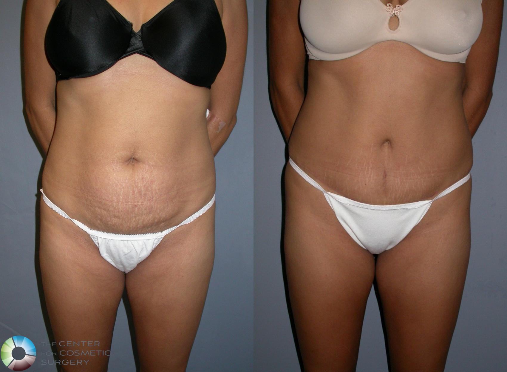 Tummy Tuck Before and After Pictures Case 216, Denver, CO