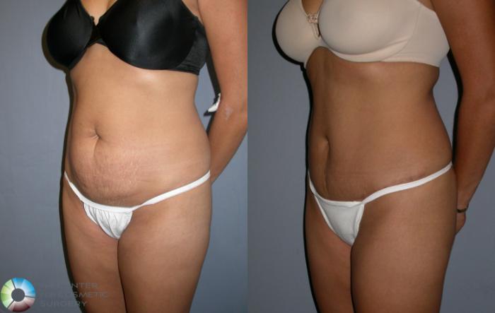 Before & After Tummy Tuck Case 216 View #2 View in Golden, CO