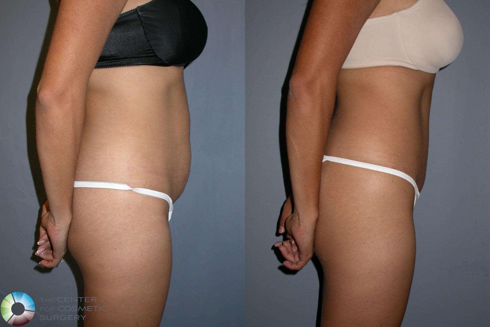 Before & After Tummy Tuck Case 216 View #3 View in Golden, CO