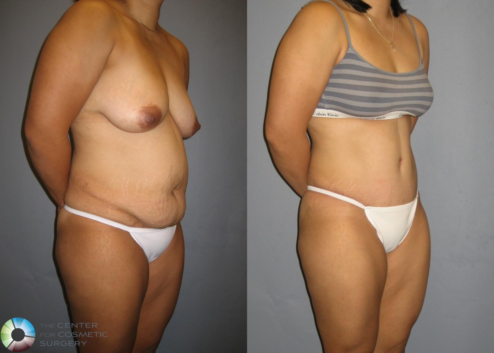 Before & After Tummy Tuck Case 220 View #1 in Denver and Colorado Springs, CO