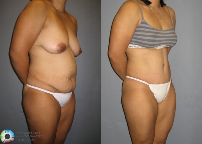 Before & After Tummy Tuck Case 220 View #1 View in Golden, CO