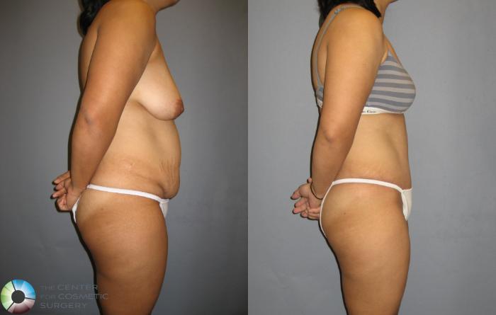 Before & After Tummy Tuck Case 220 View #2 View in Golden, CO