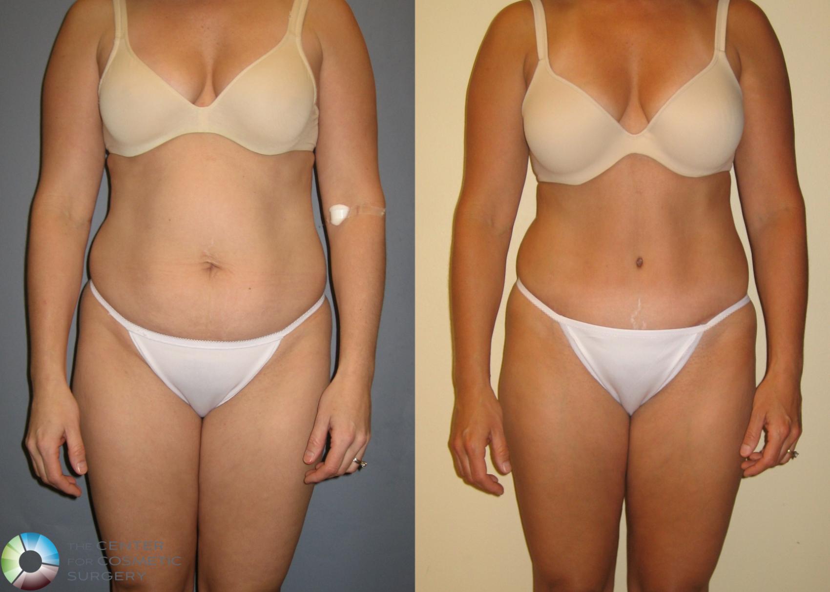 Before & After Tummy Tuck Case 227 View #1 in Denver and Colorado Springs, CO