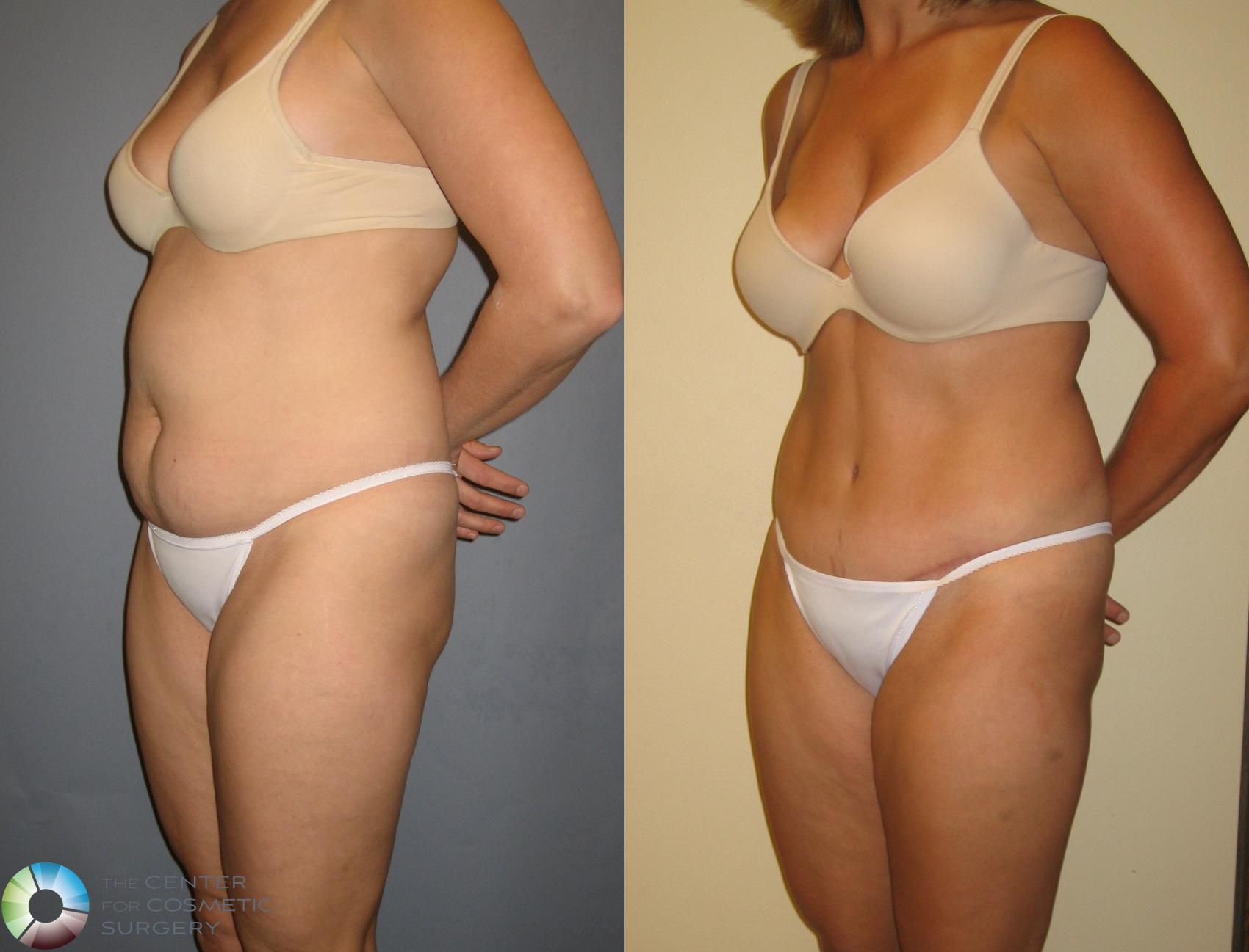 Before & After Tummy Tuck Case 227 View #2 View in Golden, CO