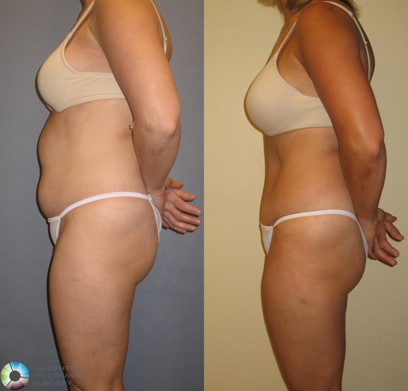 Before & After Tummy Tuck Case 227 View #3 View in Golden, CO