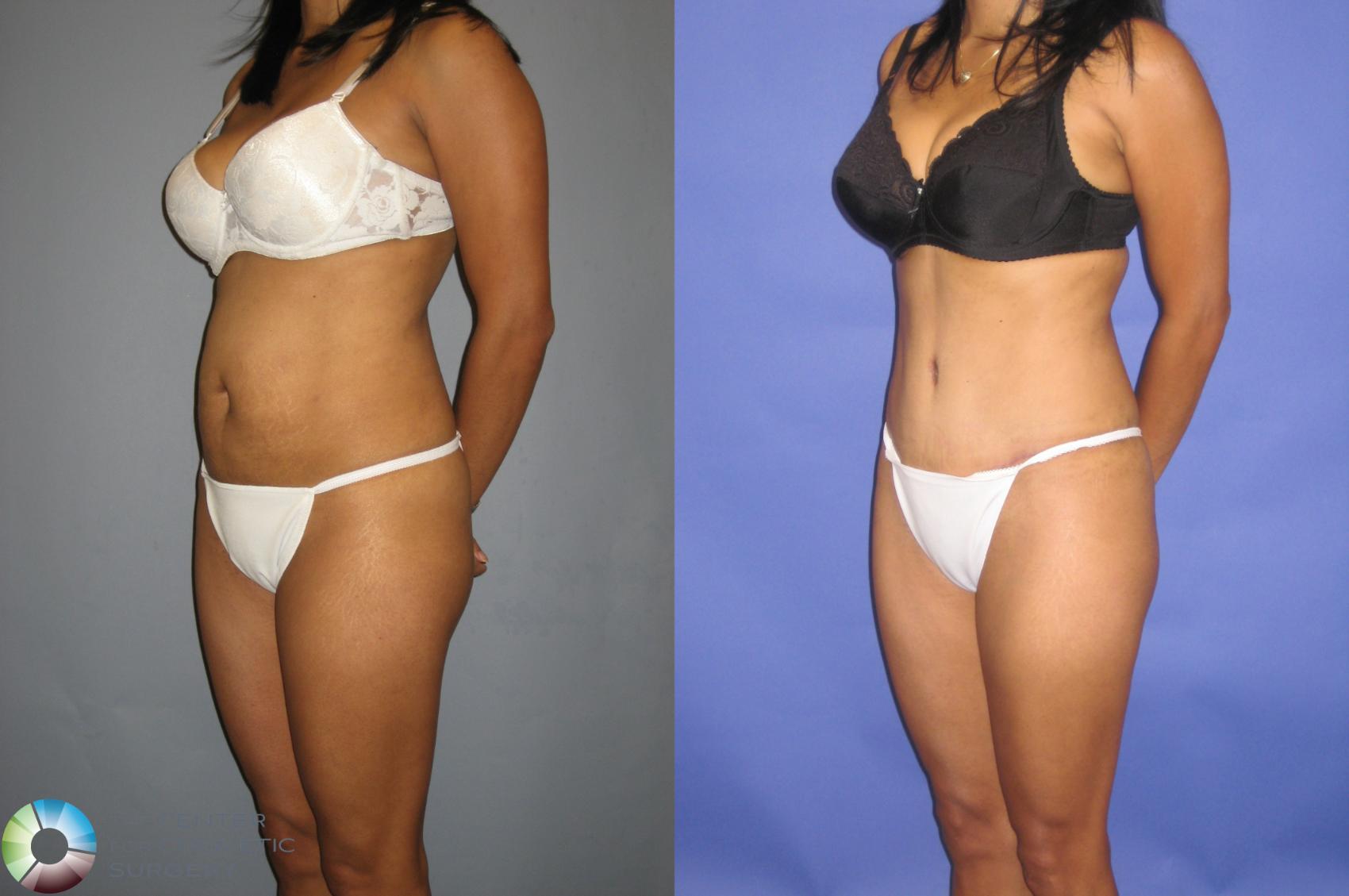 Before & After Tummy Tuck Case 229 View #1 in Denver and Colorado Springs, CO