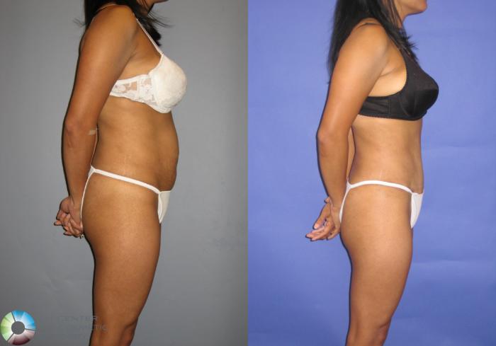 Before & After Tummy Tuck Case 229 View #2 View in Golden, CO