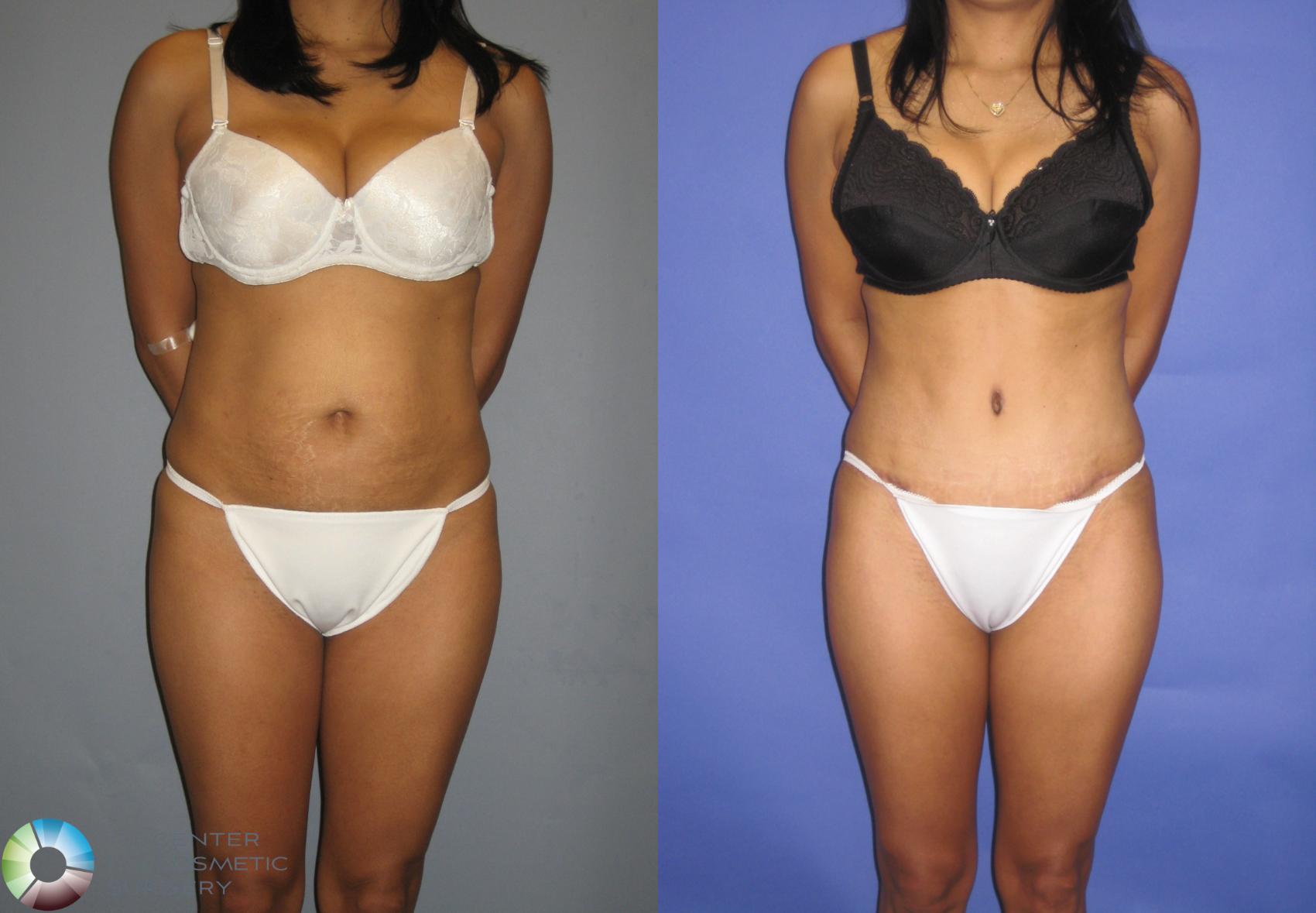 Before & After Tummy Tuck Case 229 View #3 View in Golden, CO