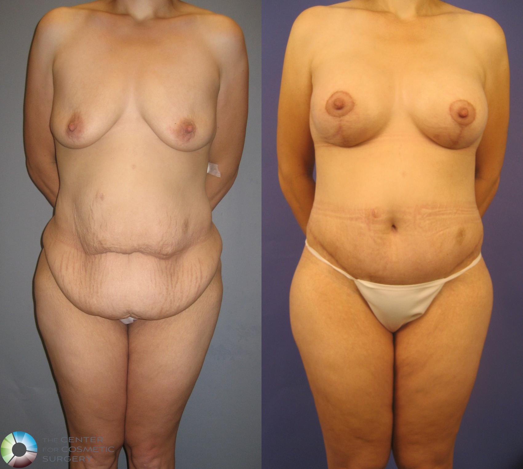 Before & After Breast Augmentation Case 232 View #1 in Denver, CO