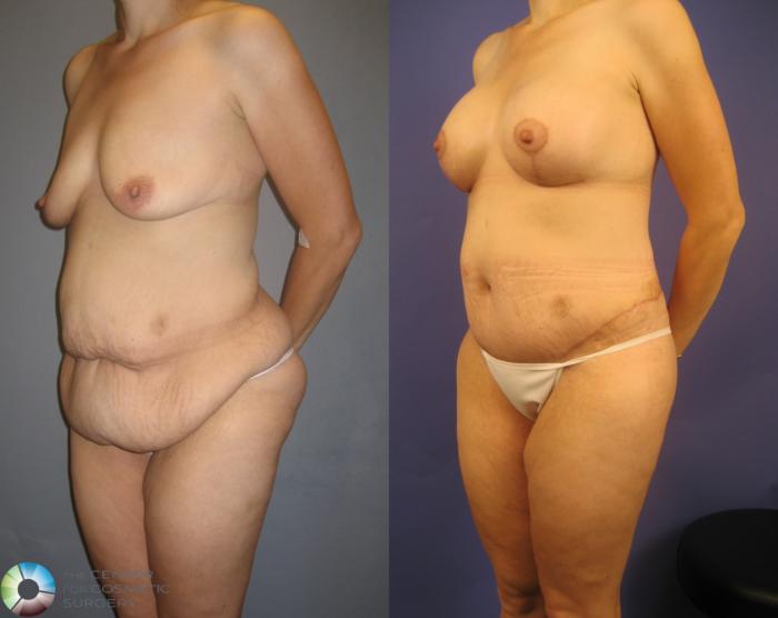 Before & After Thigh Lift Case 232 View #2 View in Golden, CO