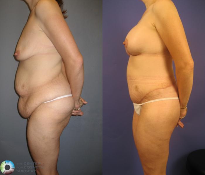 Before & After Thigh Lift Case 232 View #3 View in Golden, CO