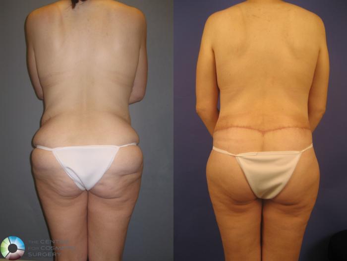 Before & After Tummy Tuck Case 232 View #4 View in Golden, CO