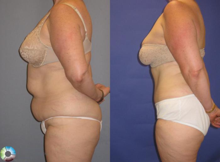 Before & After Tummy Tuck Case 248 View #1 in Denver and Colorado Springs, CO