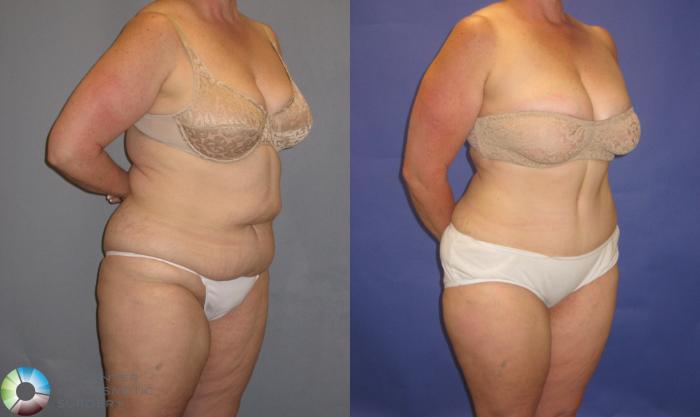 Before & After Tummy Tuck Case 248 View #2 in Denver and Colorado Springs, CO