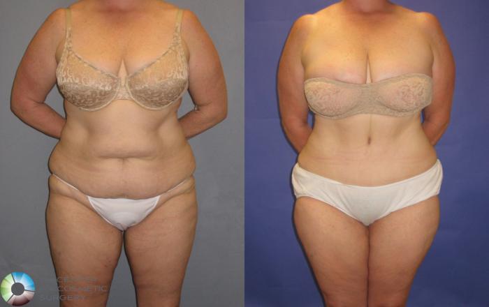 Before & After Tummy Tuck Case 248 View #3 in Denver and Colorado Springs, CO