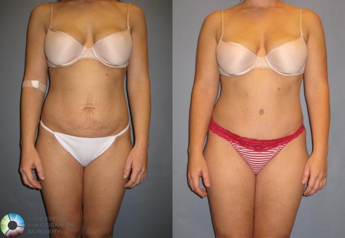 Before & After Tummy Tuck Case 271 View #1 in Denver, CO