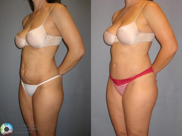 Before & After Tummy Tuck Case 271 View #2 in Denver and Colorado Springs, CO