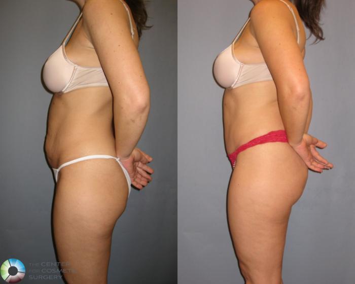 Before & After Tummy Tuck Case 271 View #3 in Denver and Colorado Springs, CO
