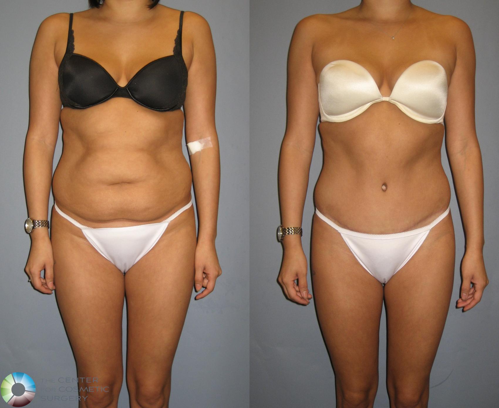 Before & After Tummy Tuck Case 298 View #1 in Denver and Colorado Springs, CO