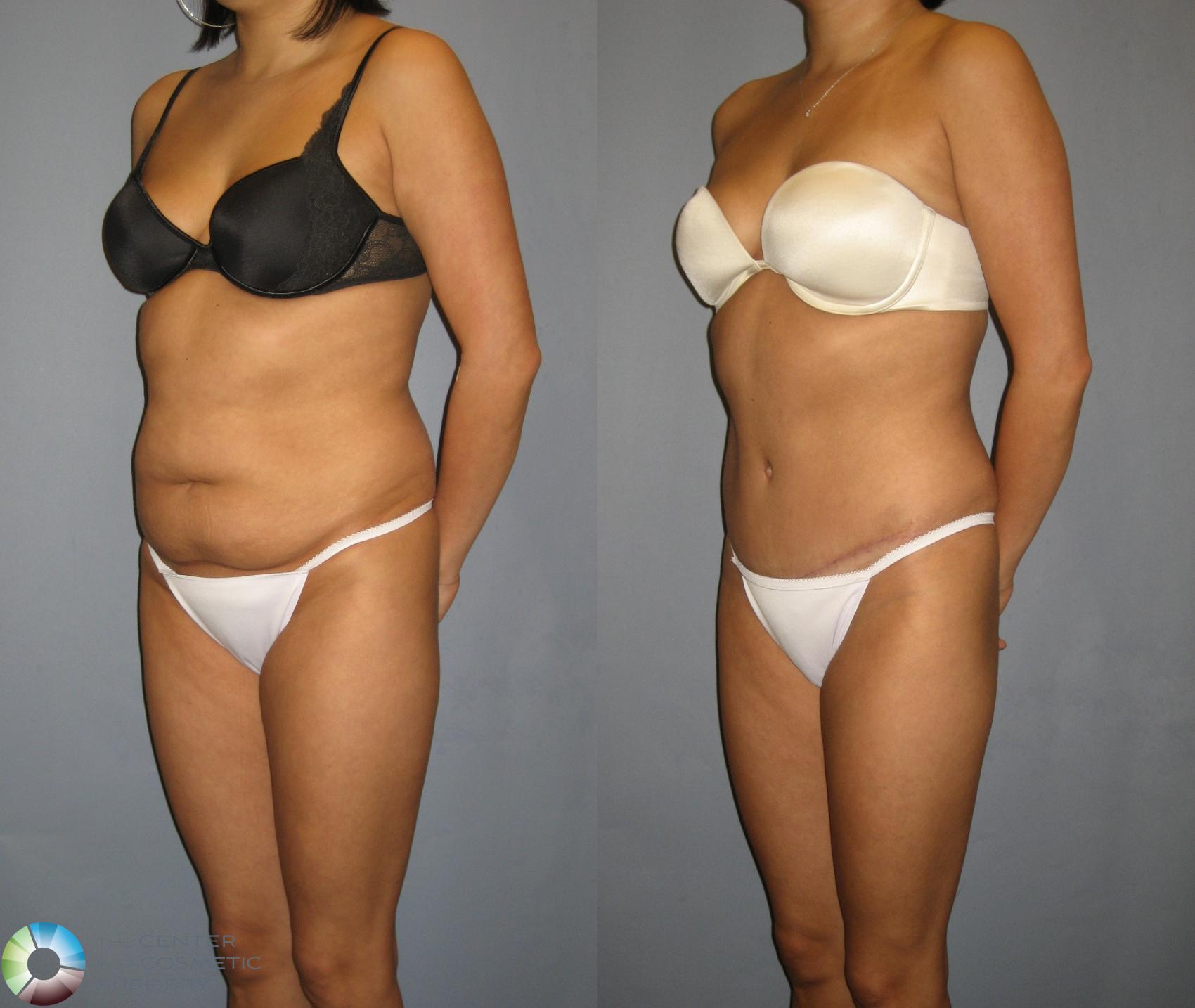 Before & After Tummy Tuck Case 298 View #2 in Denver and Colorado Springs, CO