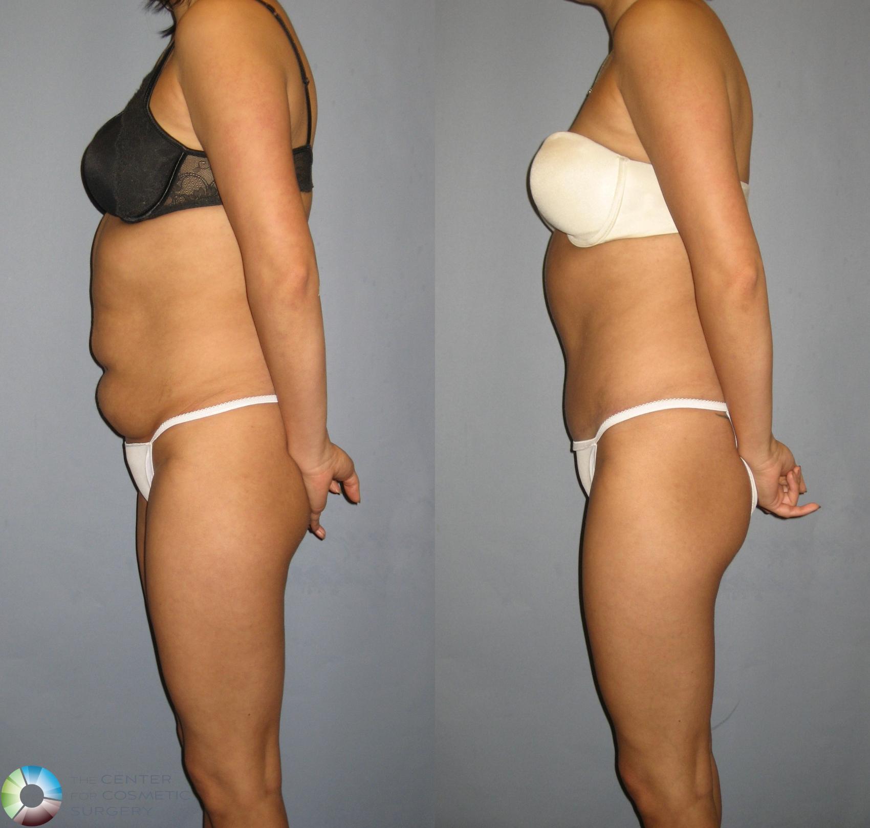 Before & After Tummy Tuck Case 298 View #3 in Denver and Colorado Springs, CO