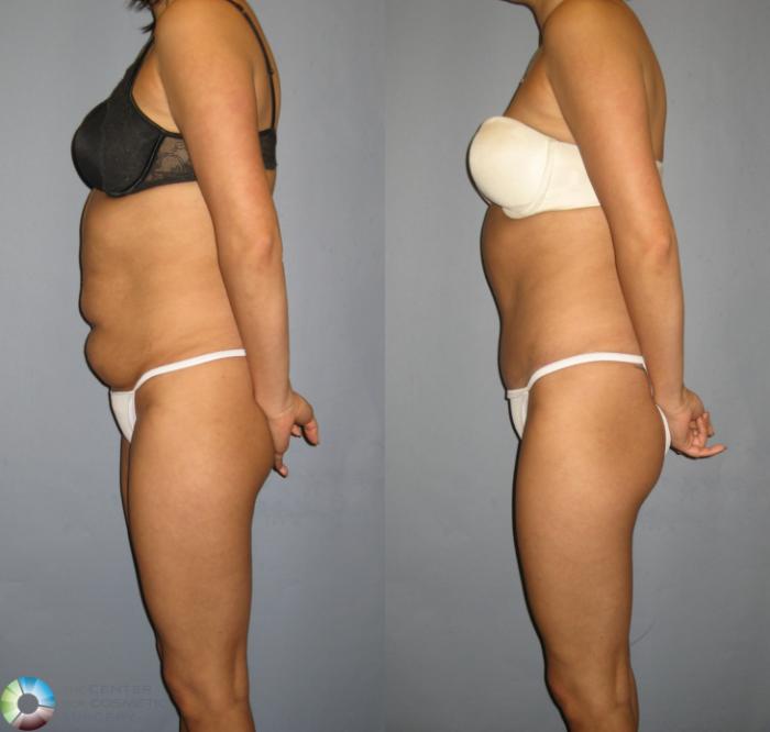 Before & After Tummy Tuck Case 298 View #3 View in Golden, CO
