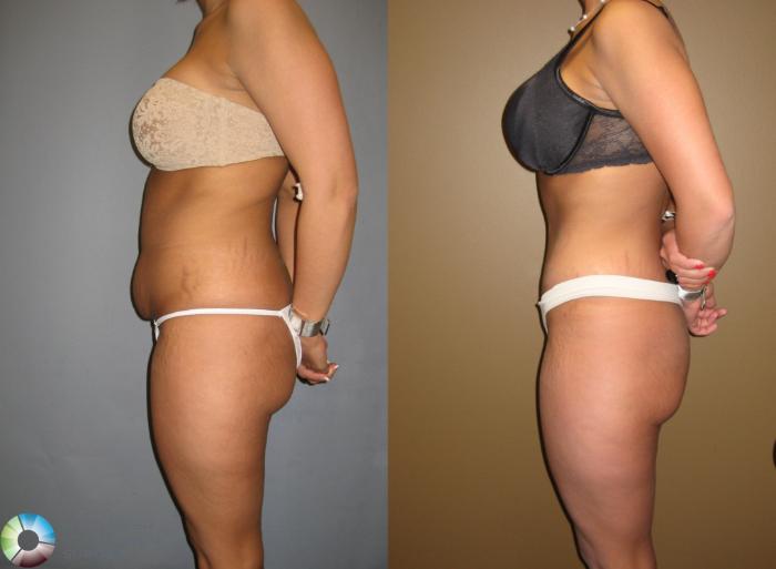 Before & After Tummy Tuck Case 302 View #2 View in Golden, CO