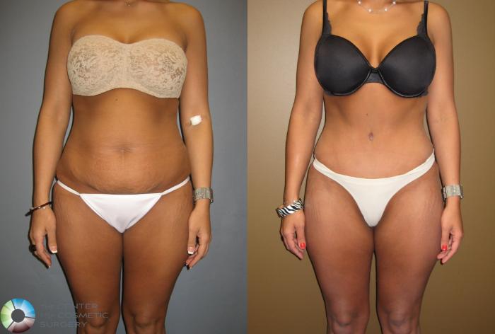 Before & After Tummy Tuck Case 302 View #3 View in Golden, CO