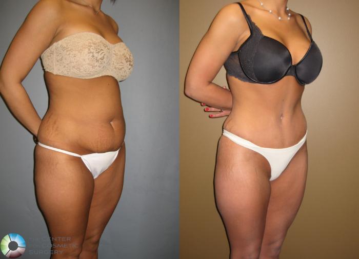 Before & After Tummy Tuck Case 302 View #4 View in Golden, CO