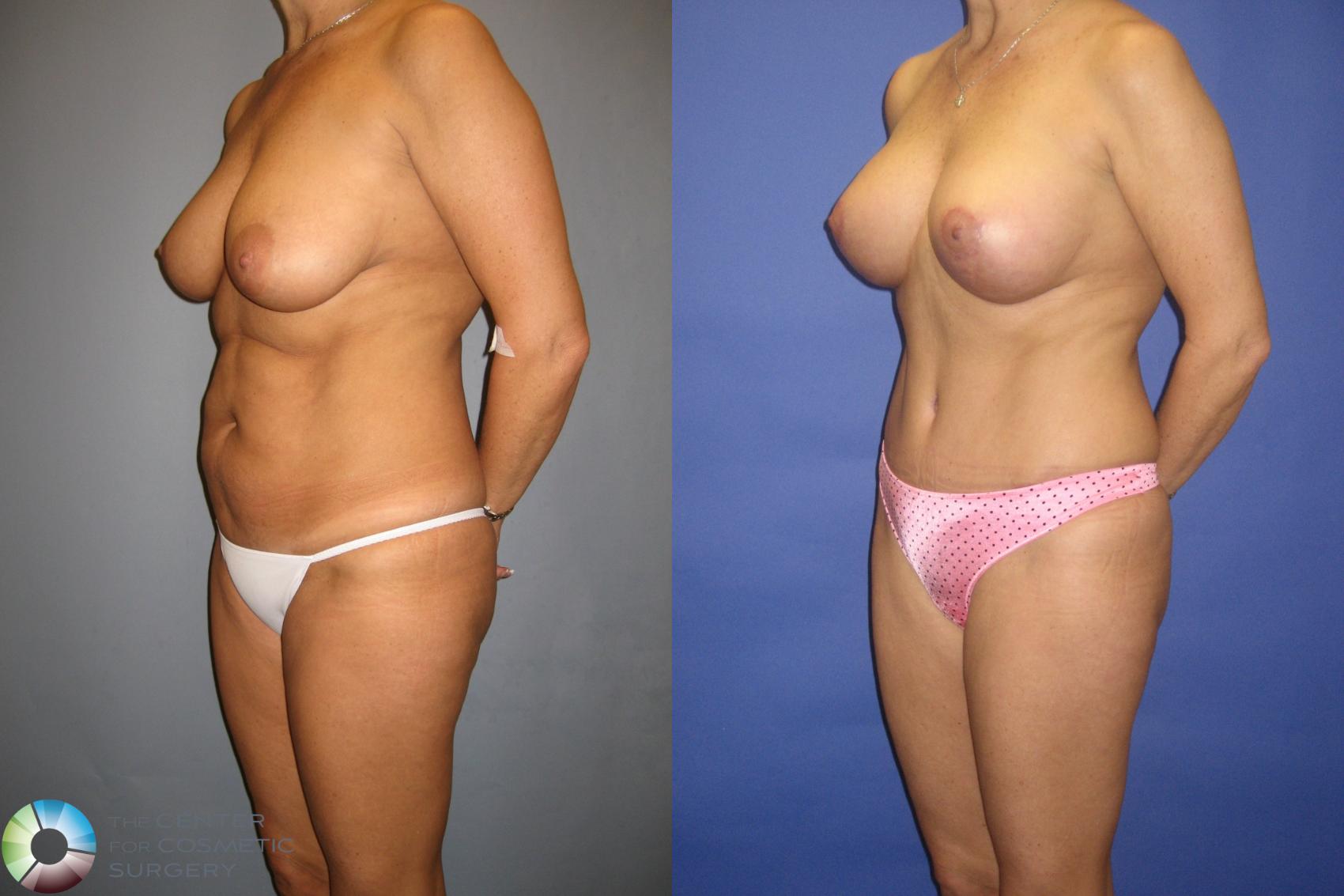 Before & After Mommy Makeover Case 305 View #1 in Denver and Colorado Springs, CO