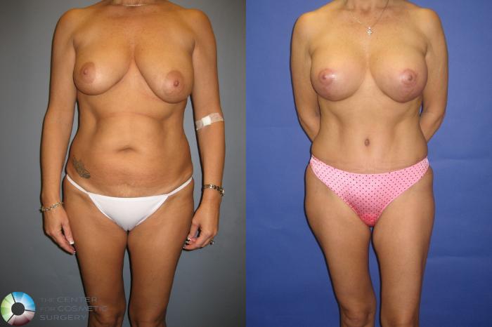 Before & After Tummy Tuck Case 305 View #2 View in Golden, CO