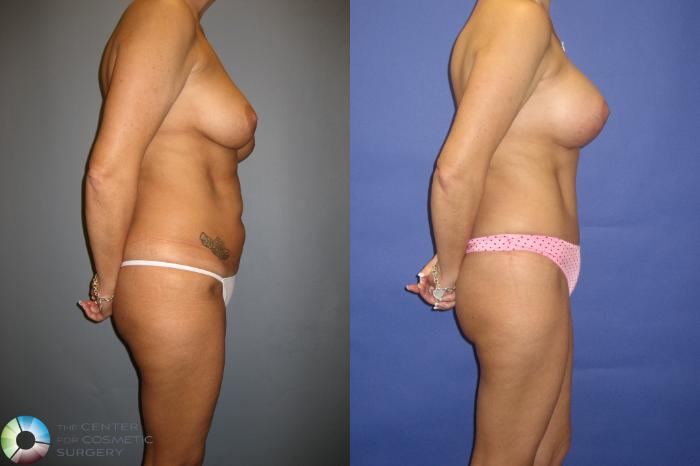 Before & After Tummy Tuck Case 305 View #3 View in Golden, CO